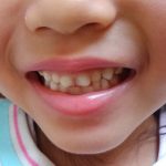 子供の歯の矯正（1）歯並びが及ぼす影響　横浜市の伊東歯科医院院長のコラム第2回
